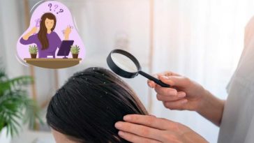 effective-home-remedies-to-treat-and-get-rid-of-dandruff