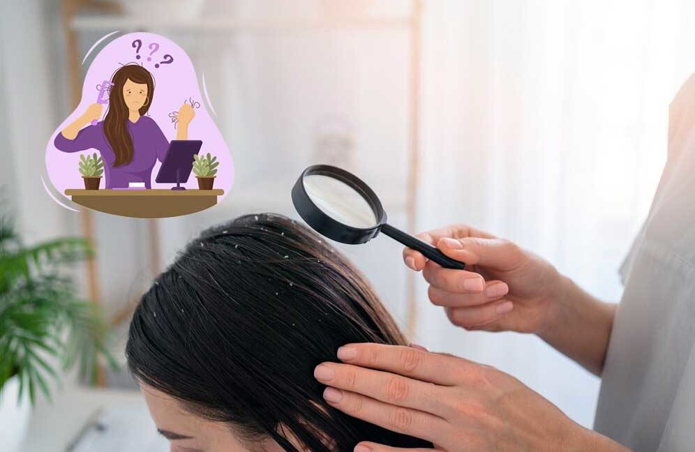 effective-home-remedies-to-treat-and-get-rid-of-dandruff