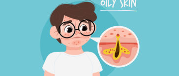 Oily-Skin-Care-in-Winter