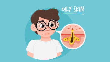 Oily-Skin-Care-in-Winter