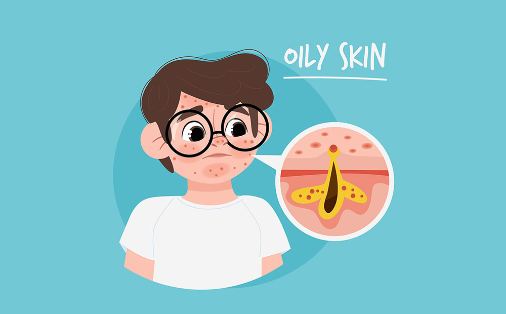 Oily-Skin-Care-in-Winter